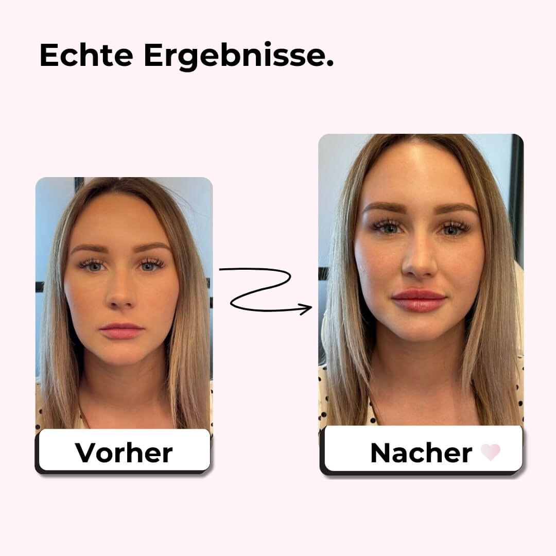 JuicyLips Lip Boost Set – Vorher-Nachher-Ergebnisse, sichtbar vollere Lippen